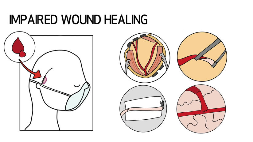 Bypass for Moyamoya Disease
